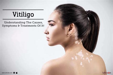 vittorio gucci vitiligine|vitiligo disease.